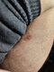 Mole/Spot/Freckle/scar removal plasma pen USD$47.61
